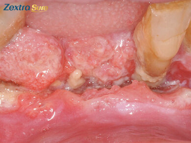 jaw-cancer-symptoms (2)